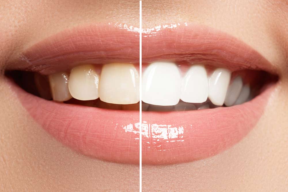 Before And After Results Of Teeth Whitening — Advanced Dental Southern Highlands In Moss Vale, NSW