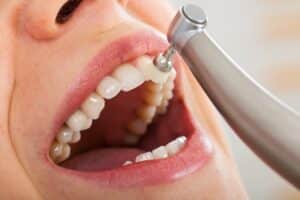 Why Professional Dental Cleanings Are Essential