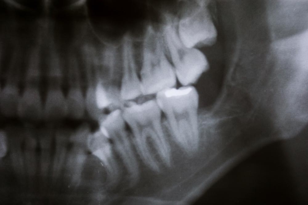 Xray With Wisdom Tooth