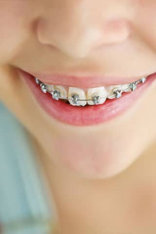 Cute Kid With Dental Braces Mobile — Advanced Dental Southern Highlands In Moss Vale, NSW