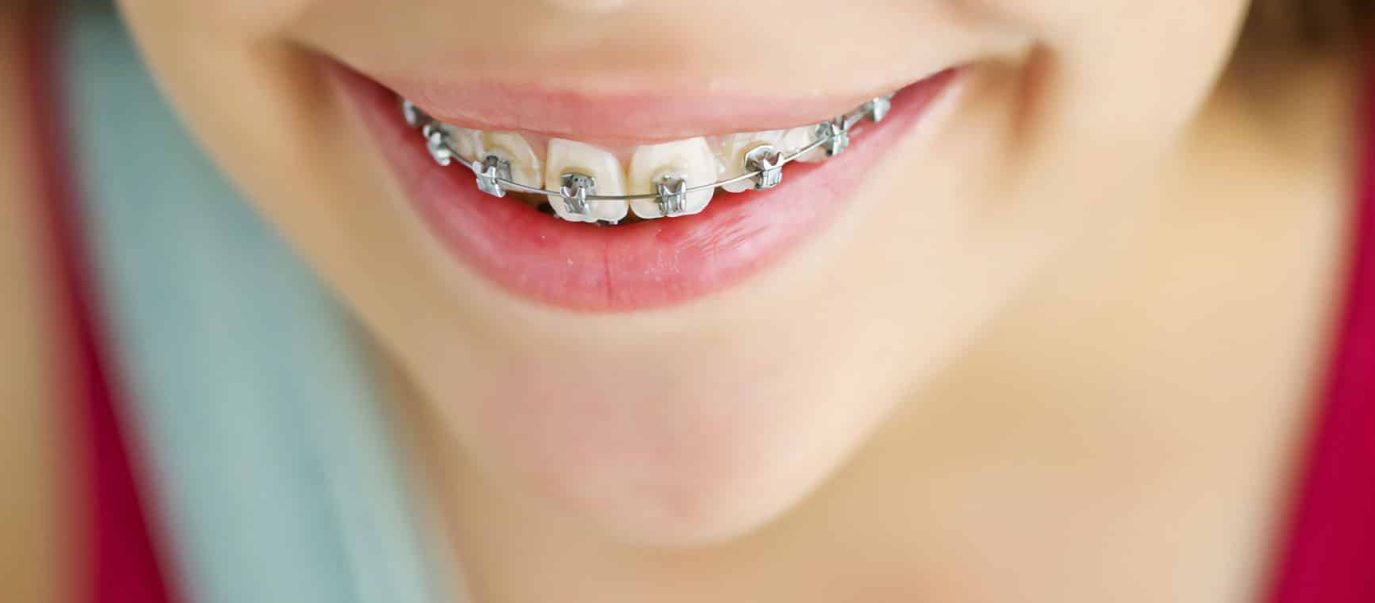 A Child in Mona Vale With Fastbraces