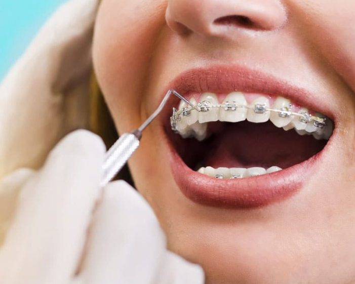 Dentist Inspecting Woman's Fastbraces in Mona Vale